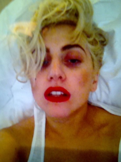 Lady Gaga black eye