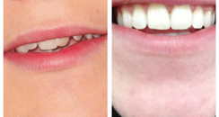 Nial Horan Befire And After Braces 