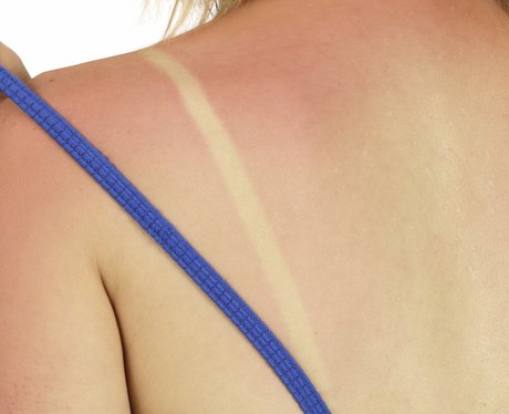 Sun Burn