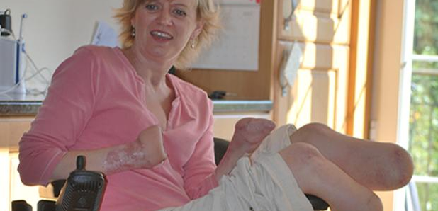 Corinne lost her hands and feet to septicaemia