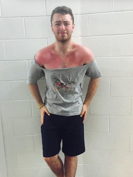 Sam Smith Sunburn
