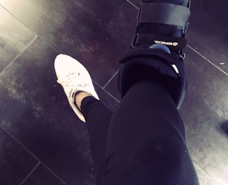 Hailey Baldwin breaks her foot exactly one year on