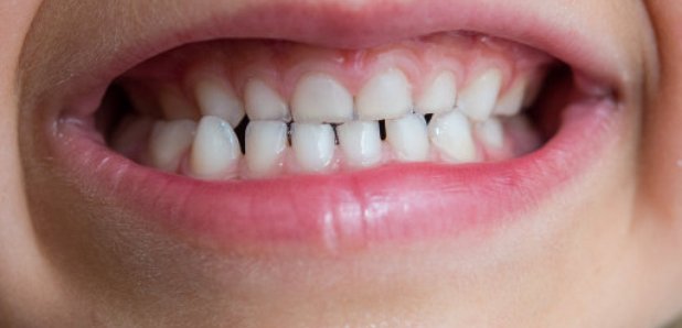 Number Of Youngsters With Tooth Decay Drops - Capital Scotland