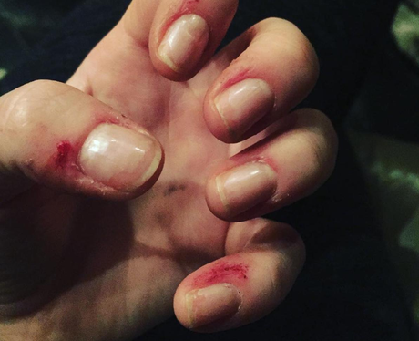 Ellie Goulding shows off hand injuries