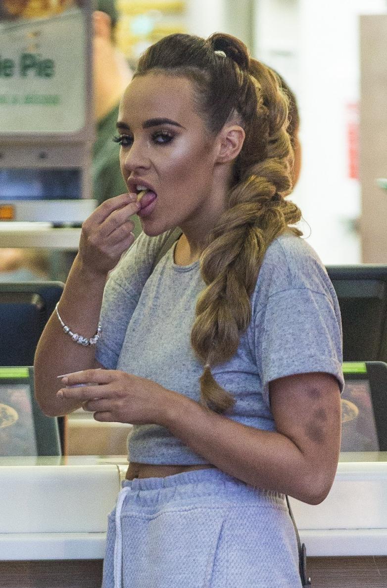 Stephanie Davis bruises