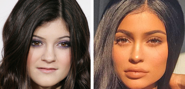 Kylie Jenner Is Refused Lip Fillers Due To Her Pregnancy ...