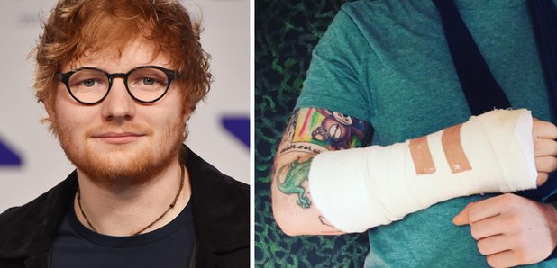 Ed Sheeran broken arm 