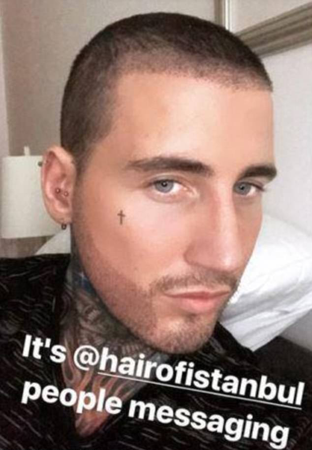 Jeremy McConnell's Hair Transplant