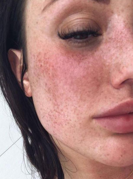Charlotte Crosby Freckles Instagram